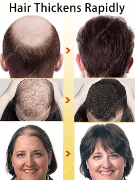 Масло для роста волос Ускоряет рост волос, эффективно устраняет облысение, наследственное выпадение волос, послеродовое выпадение волос, себорейное выпадение волос